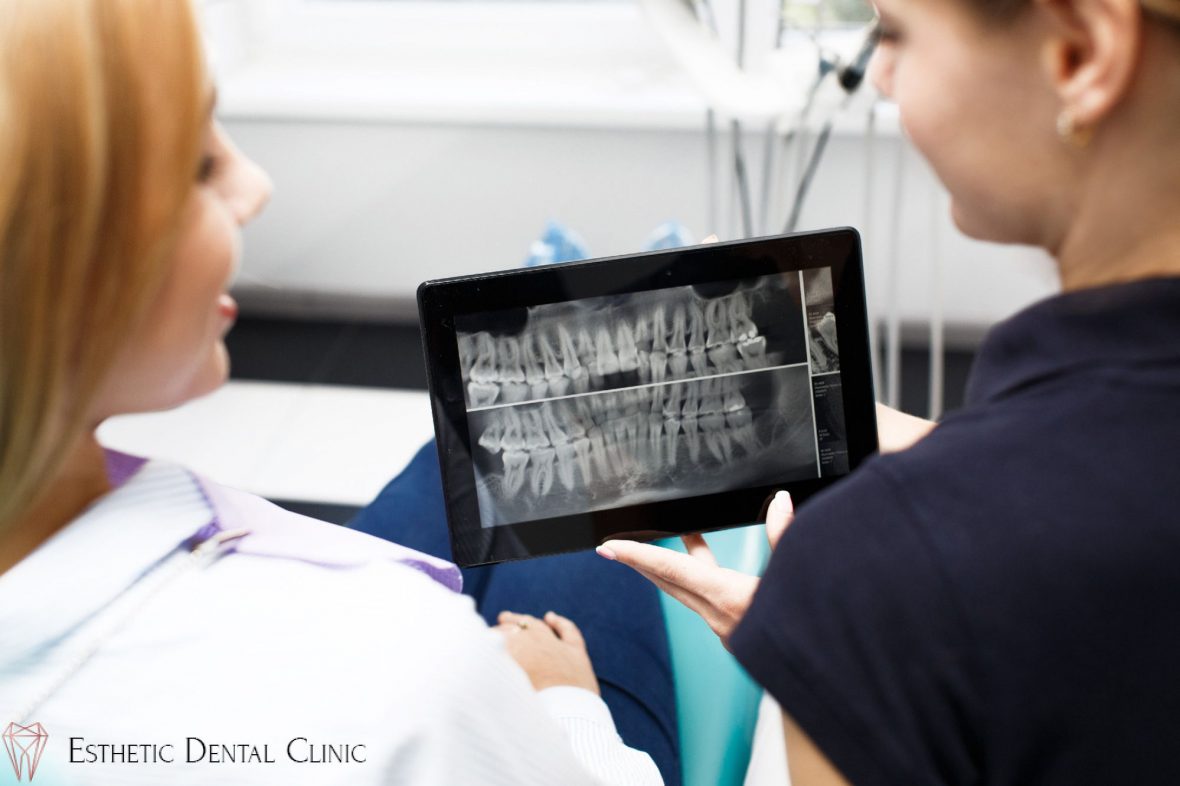 RTG zębów - prześwietlenie rentgenowskie u dentysty