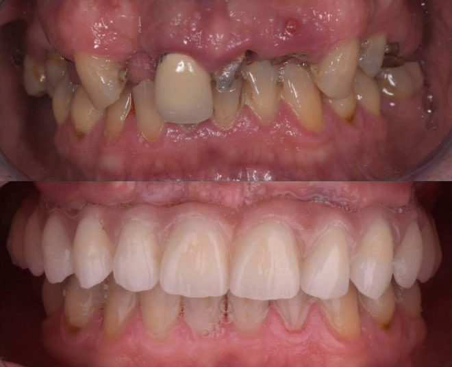 odbudowa całego łuku zębów na implantach stomatologicznych w gabinecie dentysta Toruń