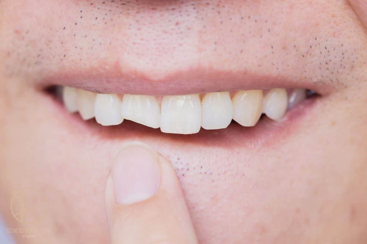 Co robić, gdy masz złamany ząb? jak najszybciej zgłoś się do dentysty