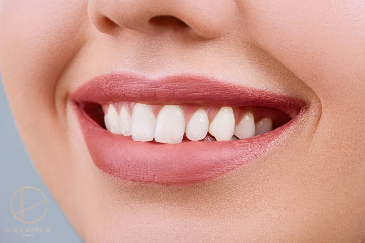 Wybielanie zębów u dentysty - co warto wiedzieć?