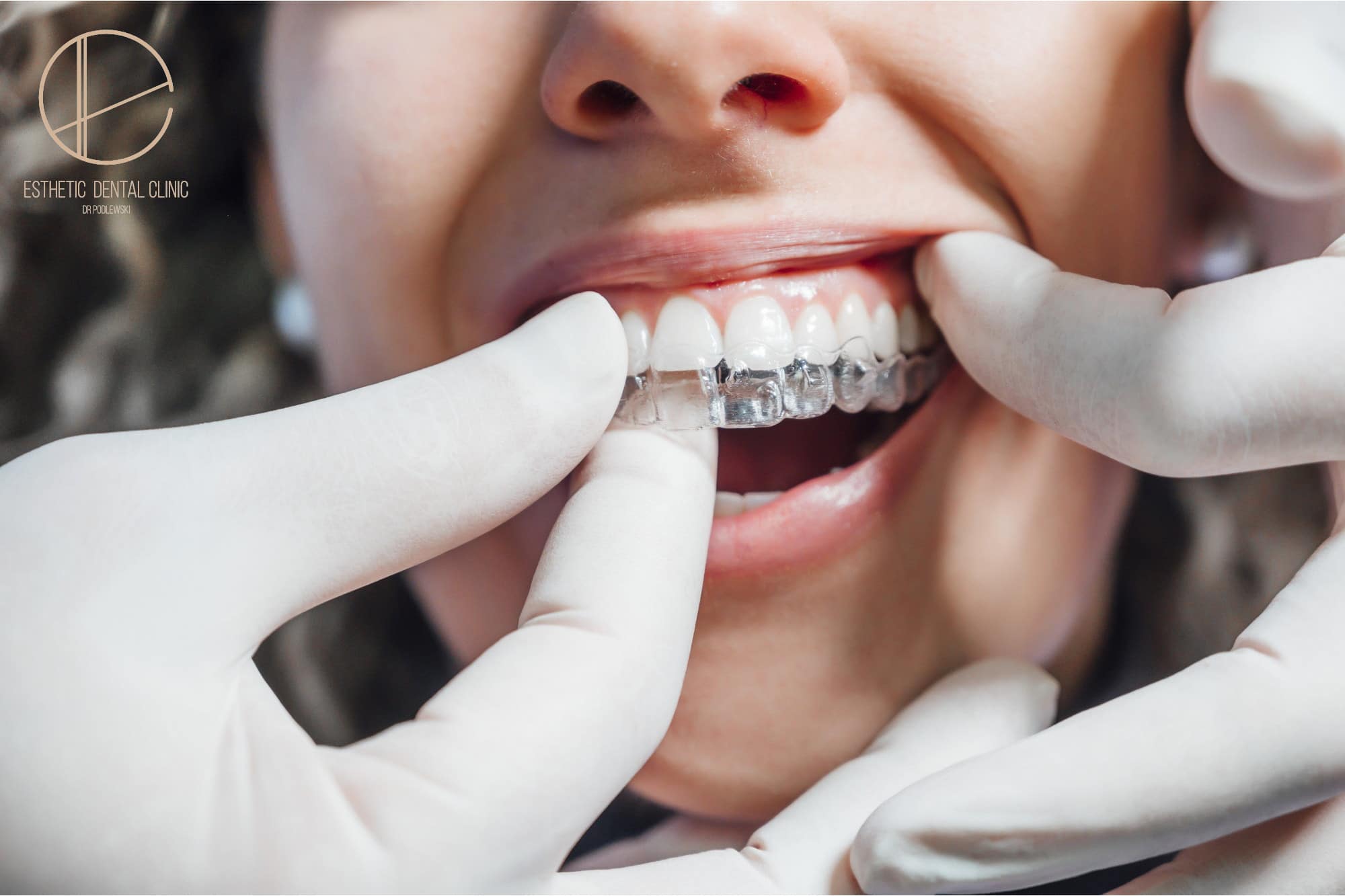 Jak Wygląda Leczenie Aparatem Ortodontycznym Invisalign — Esthetic Dental Clinic 7105