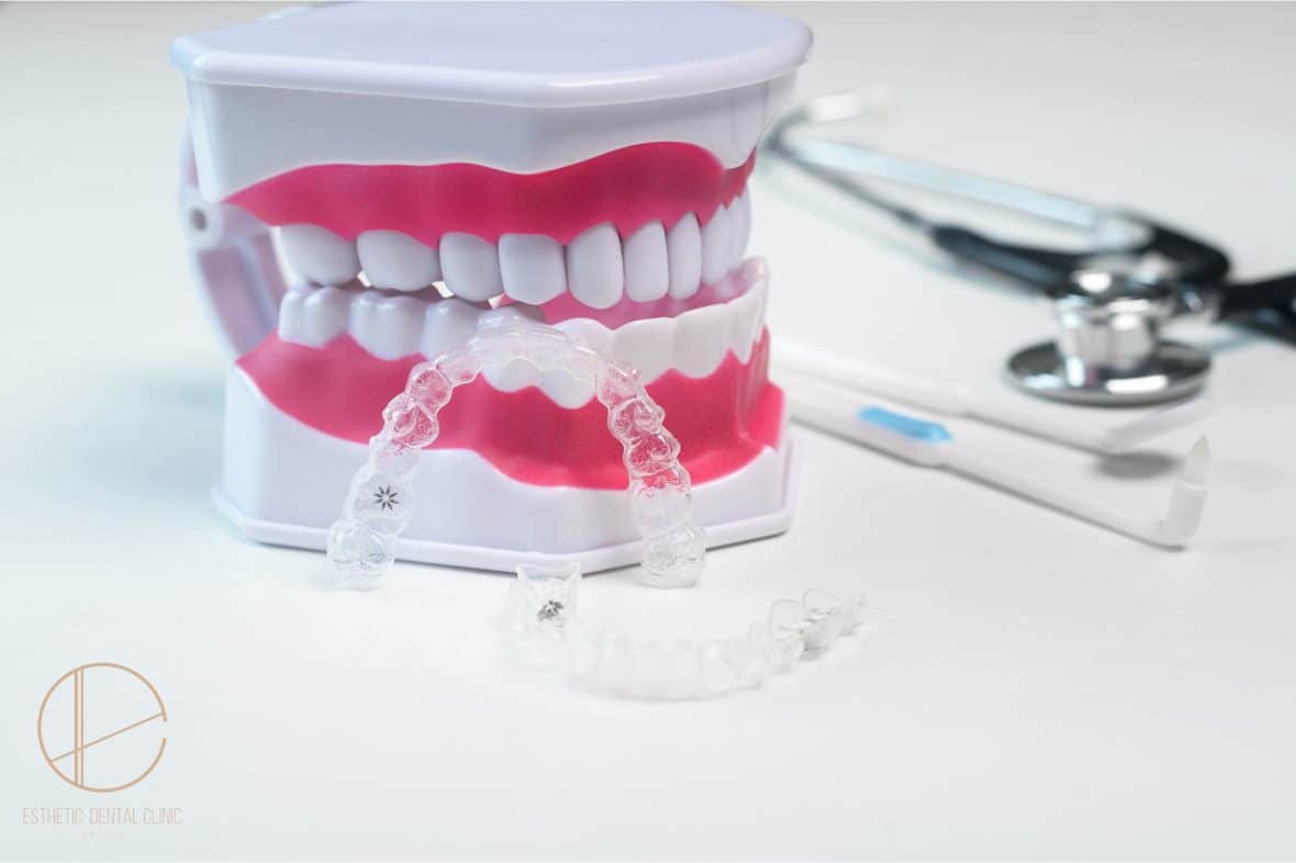 Jakie wady zgryzu leczy Invisalign niewidoczny aparat na zęby?