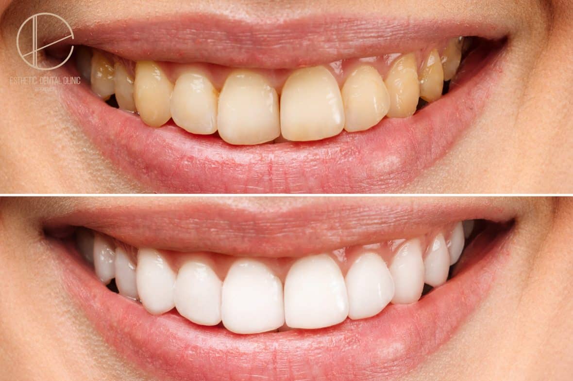 Jak utrzymać biel zębów - Wybielanie zębów Dentysta Toruń